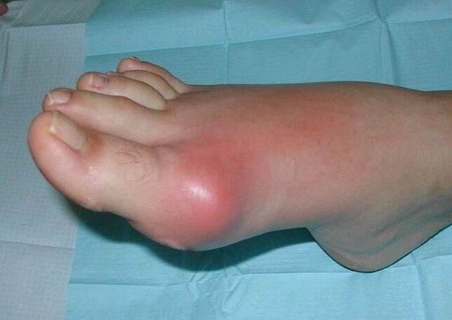 Tableau clinique de l’arthrite du pied – gonflement et inflammation