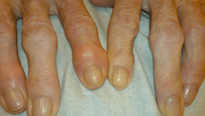 Douleur dans les articulations des doigts due à l'arthrose