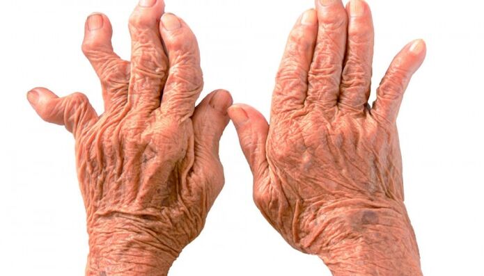 la polyarthrite rhumatoïde comme cause de douleurs dans les articulations des doigts