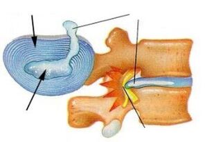 Destruction de l'anneau fibreux dans l'ostéochondrose cervicale