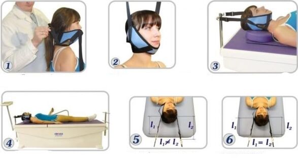 Traitement de l'ostéochondrose cervicale par traction