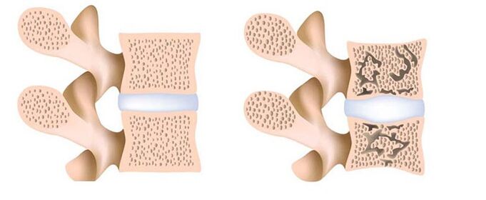 Ostéoporose - l'élimination du calcium des os