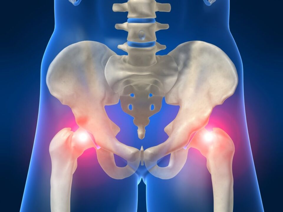 La douleur des deux côtés de l'articulation de la hanche est dérangeante dans la maladie de Bechterew