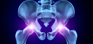l'arthrose de l'articulation de la hanche